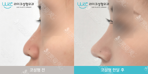 韩国LIKE来客医院鼻部整形术前后对比