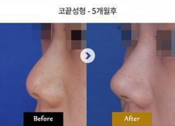 韩国金世泳整形外科鼻部整形前后照片
