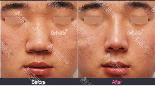 GNG医院鼻修复