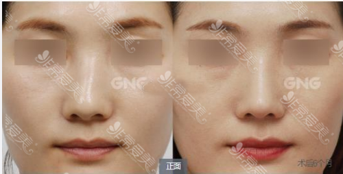 GNG医院鼻修复对比图