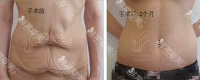 首尔slim外科腹部赘皮去除术图片