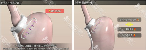 韩国首尔slim外科医院胃束带方法图