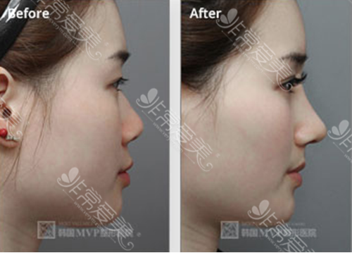 图为韩国mvp整形外科假体隆鼻手术对比日记展示