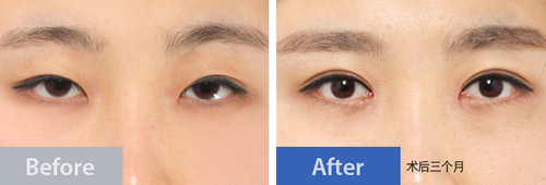 韩国梦想整形外科双眼皮案例对比