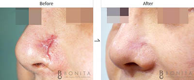 韩国BONITA整形外科疤痕修复前后照片