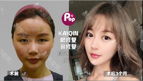 韩国鼻子整形医院中POP李炳玟Kowon三家各有哪些特色？