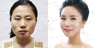 韩国JK整形外科双眼皮展示