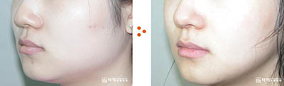 韩国她美整形外科下颌角整形案例图