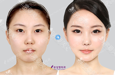 韩国必妩整形外科轮廓手术前后对比图