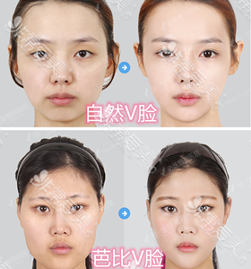 韩国必妩整形外科自然V脸与V脸对比