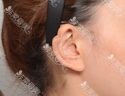 耳轮凹陷术前图