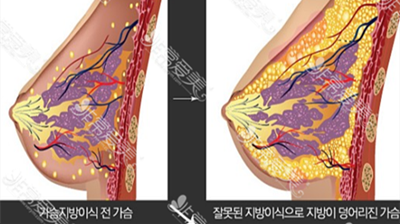 韩国star21整形外科脂肪丰胸术法展示