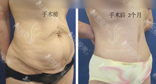 首尔slim外科医院腹部赘皮切除手术图