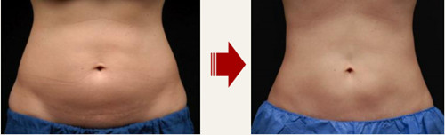 韩国童颜中心腹部溶脂前后对比图