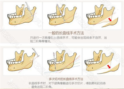 韩国拉菲安整形外科下颌骨术法详解图