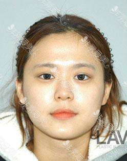 韩国拉菲安整形外科轮廓手术术前实拍