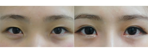 韩国江南三星双眼皮整形对比案例