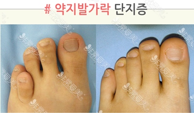 韩国rapha增高四肢整形医院短指症矫正案例
