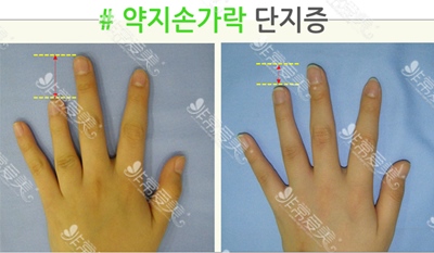 韩国rapha整形医院短指症矫正案例