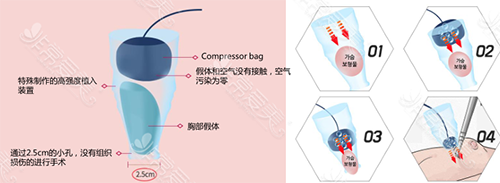 韩国K-beauty整形外科无触碰气压隆胸术法展示