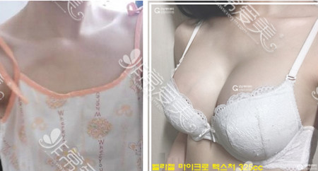 韩国K-beauty整形外科隆胸前后对比图