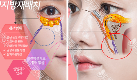 韩国K-beauty整形外科眼底脂肪重置术法展示