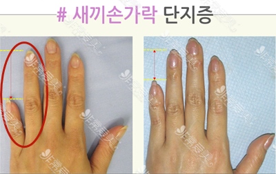 韩国rapha增高四肢整形医院短指症矫正案例