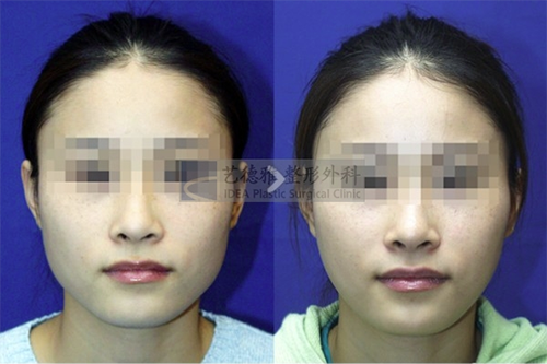 韩国艺特雅医院下颌角手术对比案例