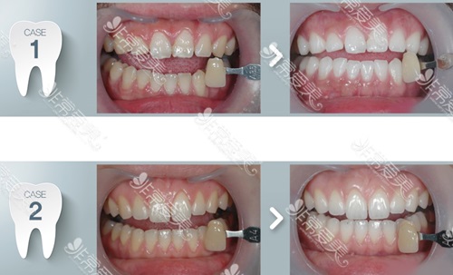 牙黄变白实用的方法是什么