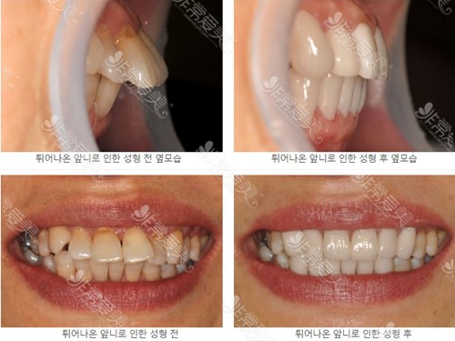 韩国延世泉牙齿畸形矫正前后对比