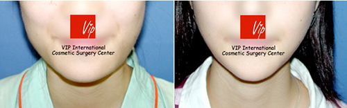下颌角整形手术对比案例