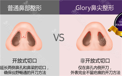 韩国glory整形外科隆鼻术法展示