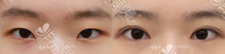 韩国IQ整形外科双眼皮术后展示图