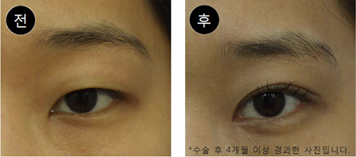 韩国SONE整形外科眼部手术对比案例