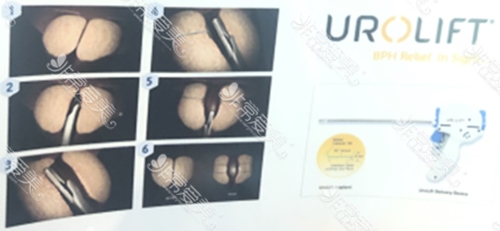 韩国世檀塔Urolift前列腺肥大微创疗法图