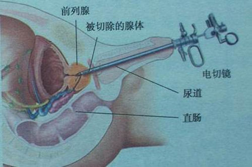 传统电切镜前列腺切除术示意图