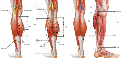 腓肠肌发达导致小腿粗壮