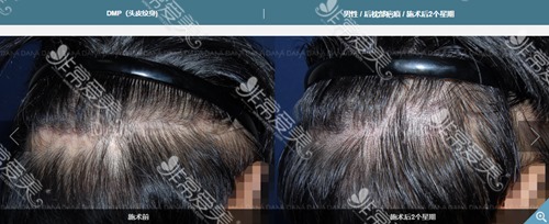 天生头发少可以加密植发吗?在韩国如果不能做植发怎么办？