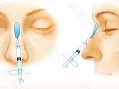 胶原蛋白隆鼻原理