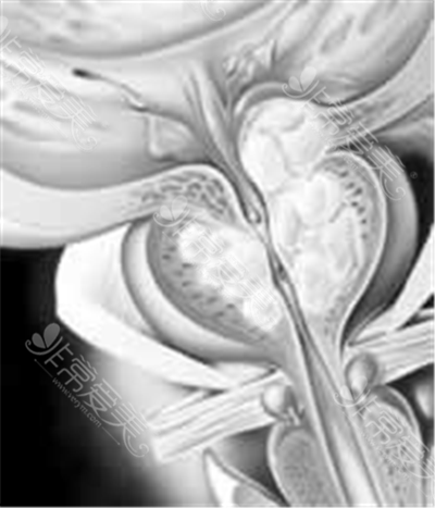 韩国世檀塔REVOLIX前列腺激光手术术后实拍图