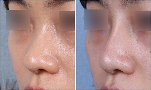 SoonPlus整形外科鼻整形案例对比图