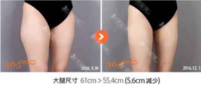 韩国365MC医院大腿吸脂效果图