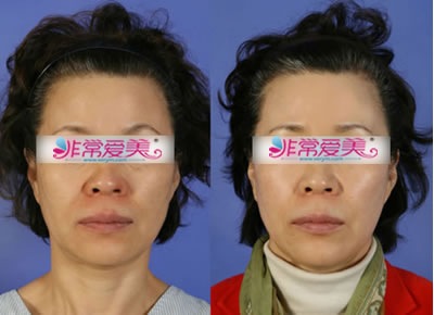 韩国BK整形外科拉皮手术对比案例