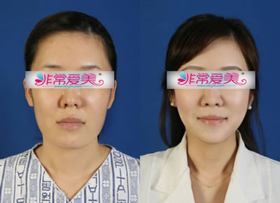 韩国BK整形外科面部轮廓整形对比案例