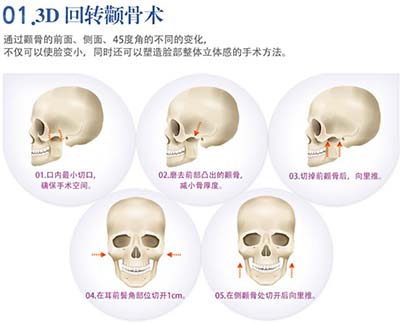 韩国BK整形医院3D回转颧骨术