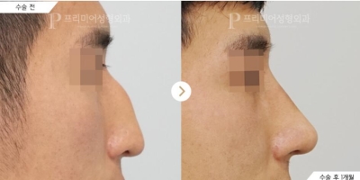 韩国普瑞美驼峰鼻矫正手术照片