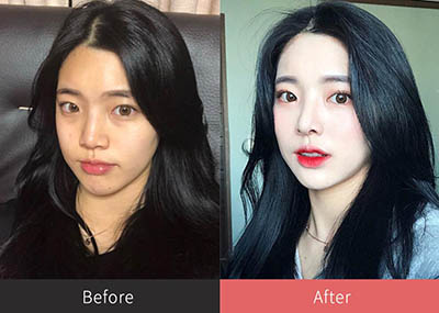 韩国普瑞美整形外科眼鼻手术前后对比照片
