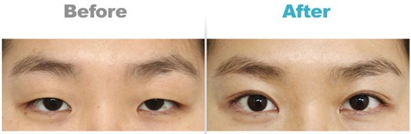 韩国春天整形外科埋线双眼皮矫正对比案例