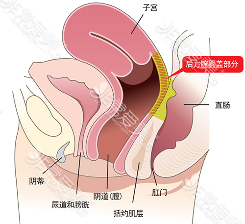 后方膣圆盖术手术位置示意图