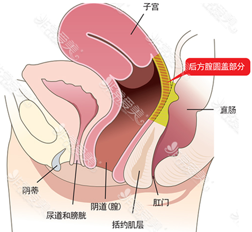 后方膣圆盖术手术位置示意图